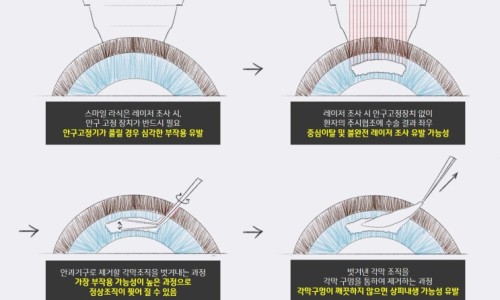 이제는 스마일 라식의 안전성에 대하여 논할 시기가 되었습니다.